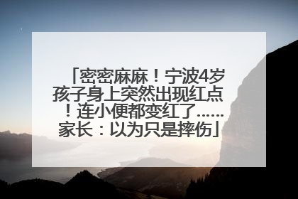 密密麻麻！宁波4岁孩子身上突然出现红点！连小便都变红了……家长：以为只是摔伤